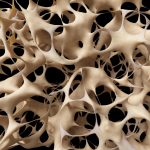 Ostseoporose bei einer Knochendichtemessung
