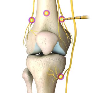Abbildung einer Coolief-Therapie am Knie